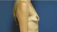 Breast Augmentation Before Photo by Tommaso Addona, MD; Garden City, NY - Case 34970