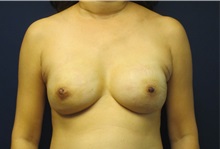 Breast Reconstruction After Photo by Tommaso Addona, MD; Garden City, NY - Case 34971