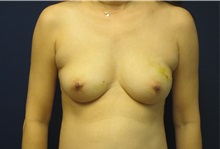 Breast Reconstruction Before Photo by Tommaso Addona, MD; Garden City, NY - Case 34971