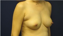 Breast Reconstruction Before Photo by Tommaso Addona, MD; Garden City, NY - Case 34971