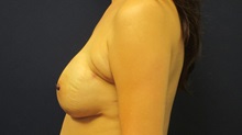 Breast Reconstruction After Photo by Tommaso Addona, MD; Garden City, NY - Case 34971