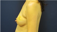 Breast Reconstruction Before Photo by Tommaso Addona, MD; Garden City, NY - Case 34971