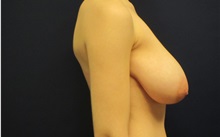 Breast Reduction Before Photo by Tommaso Addona, MD; Garden City, NY - Case 34976