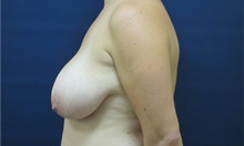 Breast Reduction Before Photo by Tommaso Addona, MD; Garden City, NY - Case 34980