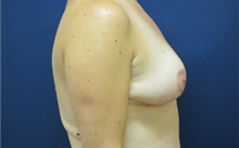 Breast Reduction After Photo by Tommaso Addona, MD; Garden City, NY - Case 34980