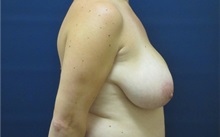 Breast Reduction Before Photo by Tommaso Addona, MD; Garden City, NY - Case 34980