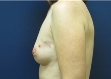 Breast Reconstruction Before Photo by Tommaso Addona, MD; Garden City, NY - Case 34982