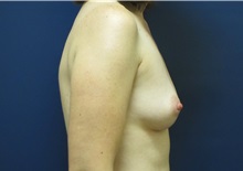 Breast Reconstruction Before Photo by Tommaso Addona, MD; Garden City, NY - Case 34982