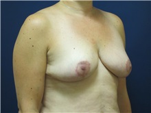 Breast Reduction After Photo by Tommaso Addona, MD; Garden City, NY - Case 36702