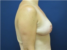 Breast Reduction After Photo by Tommaso Addona, MD; Garden City, NY - Case 36702