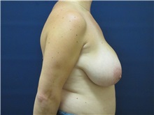 Breast Reduction Before Photo by Tommaso Addona, MD; Garden City, NY - Case 36702