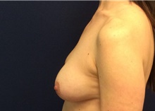 Breast Reconstruction Before Photo by Tommaso Addona, MD; Garden City, NY - Case 40819