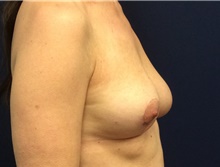 Breast Reconstruction Before Photo by Tommaso Addona, MD; Garden City, NY - Case 40819