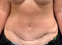 Tummy Tuck After Photo by Tommaso Addona, MD; Garden City, NY - Case 40820