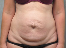 Tummy Tuck Before Photo by Tommaso Addona, MD; Garden City, NY - Case 40820