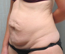 Tummy Tuck Before Photo by Tommaso Addona, MD; Garden City, NY - Case 40820