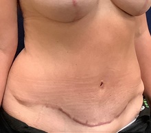 Tummy Tuck After Photo by Tommaso Addona, MD; Garden City, NY - Case 40820