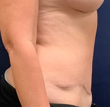 Tummy Tuck After Photo by Tommaso Addona, MD; Garden City, NY - Case 40820