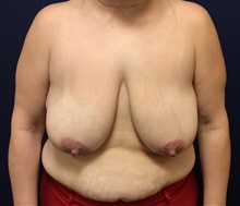 Breast Reduction Before Photo by Tommaso Addona, MD; Garden City, NY - Case 40821