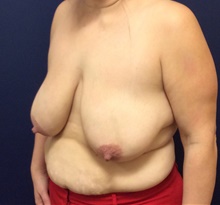 Breast Reduction Before Photo by Tommaso Addona, MD; Garden City, NY - Case 40821