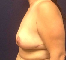 Breast Reduction After Photo by Tommaso Addona, MD; Garden City, NY - Case 40821