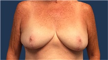 Breast Reduction After Photo by Tommaso Addona, MD; Garden City, NY - Case 40823