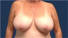 Breast Reduction Before Photo by Tommaso Addona, MD; Garden City, NY - Case 40823