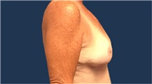 Breast Reduction After Photo by Tommaso Addona, MD; Garden City, NY - Case 40823