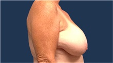 Breast Reduction Before Photo by Tommaso Addona, MD; Garden City, NY - Case 40823