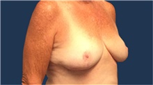 Breast Reduction After Photo by Tommaso Addona, MD; Garden City, NY - Case 40823