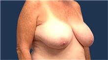 Breast Reduction Before Photo by Tommaso Addona, MD; Garden City, NY - Case 40823