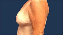 Breast Reduction After Photo by Tommaso Addona, MD; Garden City, NY - Case 40823