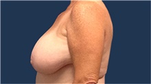 Breast Reduction Before Photo by Tommaso Addona, MD; Garden City, NY - Case 40823