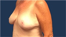 Breast Reduction After Photo by Tommaso Addona, MD; Garden City, NY - Case 40823