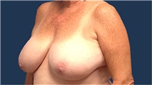 Breast Reduction Before Photo by Tommaso Addona, MD; Garden City, NY - Case 40823