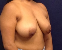 Breast Reduction Before Photo by Tommaso Addona, MD; Garden City, NY - Case 40826