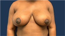 Breast Reduction After Photo by Tommaso Addona, MD; Garden City, NY - Case 40829