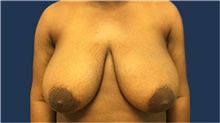 Breast Reduction Before Photo by Tommaso Addona, MD; Garden City, NY - Case 40829