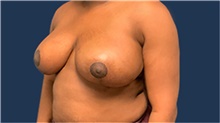 Breast Reduction After Photo by Tommaso Addona, MD; Garden City, NY - Case 40829