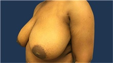 Breast Reduction Before Photo by Tommaso Addona, MD; Garden City, NY - Case 40829