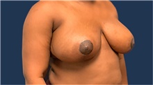 Breast Reduction After Photo by Tommaso Addona, MD; Garden City, NY - Case 40829