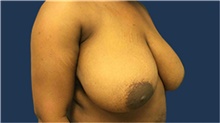 Breast Reduction Before Photo by Tommaso Addona, MD; Garden City, NY - Case 40829