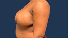 Breast Reduction After Photo by Tommaso Addona, MD; Garden City, NY - Case 40829