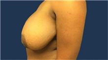 Breast Reduction Before Photo by Tommaso Addona, MD; Garden City, NY - Case 40829