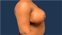 Breast Reduction After Photo by Tommaso Addona, MD; Garden City, NY - Case 40829