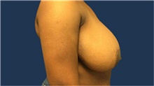 Breast Reduction Before Photo by Tommaso Addona, MD; Garden City, NY - Case 40829