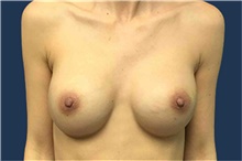 Breast Augmentation After Photo by Tommaso Addona, MD; Garden City, NY - Case 41039