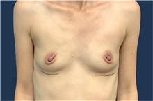 Breast Augmentation Before Photo by Tommaso Addona, MD; Garden City, NY - Case 41039