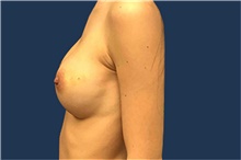 Breast Augmentation After Photo by Tommaso Addona, MD; Garden City, NY - Case 41039