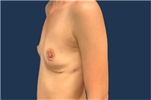 Breast Augmentation Before Photo by Tommaso Addona, MD; Garden City, NY - Case 41039